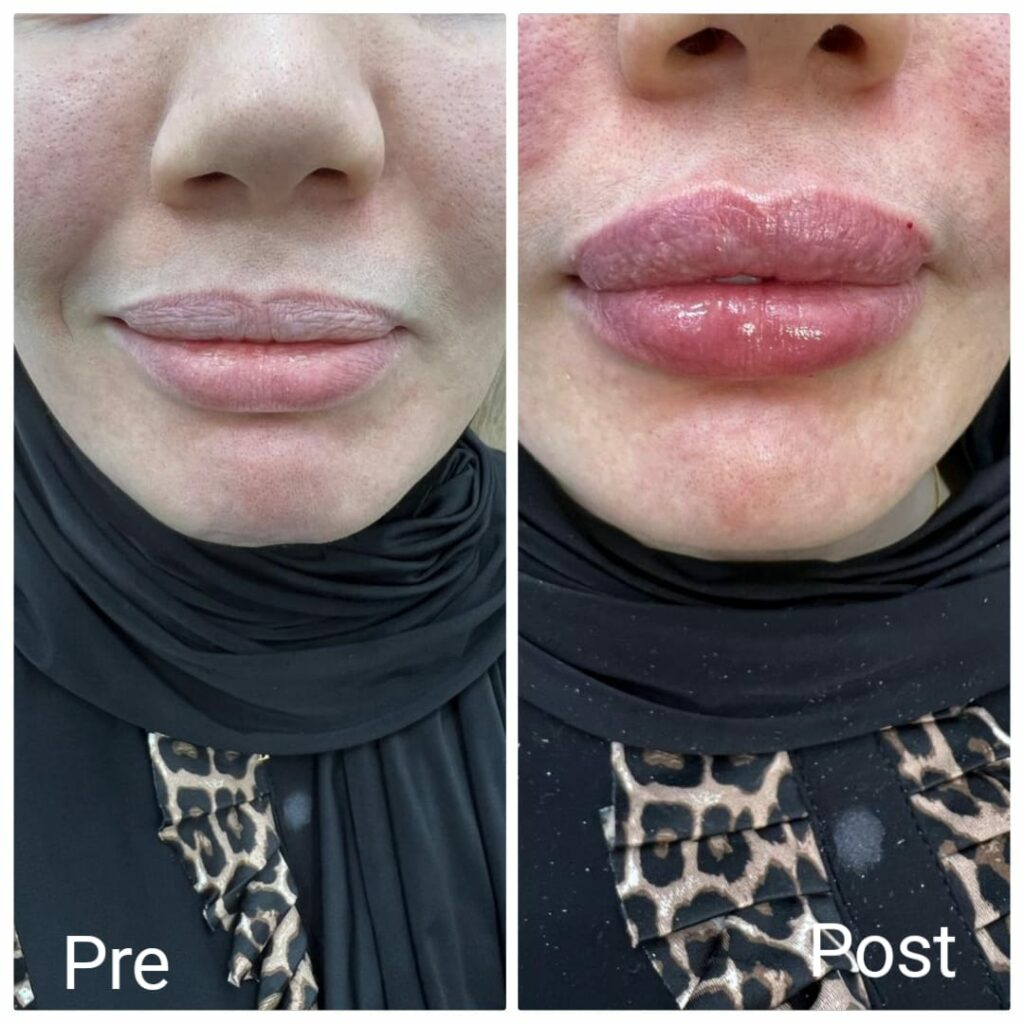 نتيجة حقن الهيالورونيك أسيد للشفايف قبل وبعد